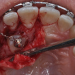 DSC 0005 copia 150x150 Chirurgia orale
